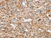 The image on the left is immunohistochemistry of paraffin-embedded Human liver cancer tissue using CSB-PA048443 (SNX15 Antibody) at dilution 1/20, on the right is treated with fusion protein. (Original magnification: ×200)