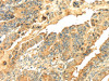 The image on the left is immunohistochemistry of paraffin-embedded Human esophagus cancer tissue using CSB-PA985197 (SNX20 Antibody) at dilution 1/20, on the right is treated with fusion protein. (Original magnification: ×200)