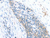 The image on the left is immunohistochemistry of paraffin-embedded Human esophagus cancer tissue using CSB-PA213445 (SFTPA1 Antibody) at dilution 1/40, on the right is treated with fusion protein. (Original magnification: ×200)