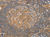 The image on the left is immunohistochemistry of paraffin-embedded Human tonsil tissue using CSB-PA869737 (SRGAP3 Antibody) at dilution 1/30, on the right is treated with fusion protein. (Original magnification: ×200)