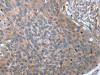 The image on the left is immunohistochemistry of paraffin-embedded Human esophagus cancer tissue using CSB-PA869737 (SRGAP3 Antibody) at dilution 1/30, on the right is treated with fusion protein. (Original magnification: ×200)