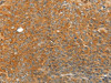 The image on the left is immunohistochemistry of paraffin-embedded Human ovarian cancer tissue using CSB-PA173569 (TRIM21 Antibody) at dilution 1/20, on the right is treated with fusion protein. (Original magnification: ×200)