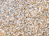 The image on the left is immunohistochemistry of paraffin-embedded Human prostate cancer tissue using CSB-PA166947 (SDCBP Antibody) at dilution 1/40, on the right is treated with fusion protein. (Original magnification: ×200)