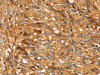 The image on the left is immunohistochemistry of paraffin-embedded Human breast cancer tissue using CSB-PA631492 (STC1 Antibody) at dilution 1/20, on the right is treated with fusion protein. (Original magnification: ×200)