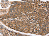The image on the left is immunohistochemistry of paraffin-embedded Human lung cancer tissue using CSB-PA631492 (STC1 Antibody) at dilution 1/20, on the right is treated with fusion protein. (Original magnification: ×200)