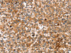 The image on the left is immunohistochemistry of paraffin-embedded Human lung cancer tissue using CSB-PA174690 (STAR Antibody) at dilution 1/35, on the right is treated with fusion protein. (Original magnification: ×200)