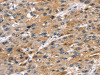 The image on the left is immunohistochemistry of paraffin-embedded Human liver cancer tissue using CSB-PA108943 (STK33 Antibody) at dilution 1/45, on the right is treated with fusion protein. (Original magnification: ×200)