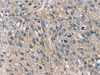 The image on the left is immunohistochemistry of paraffin-embedded Human breast cancer tissue using CSB-PA108943 (STK33 Antibody) at dilution 1/45, on the right is treated with fusion protein. (Original magnification: ×200)