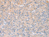 The image on the left is immunohistochemistry of paraffin-embedded Human liver cancer tissue using CSB-PA041746 (STK16 Antibody) at dilution 1/25, on the right is treated with fusion protein. (Original magnification: ×200)
