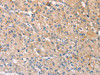 The image on the left is immunohistochemistry of paraffin-embedded Human liver cancer tissue using CSB-PA781981 (STK16 Antibody) at dilution 1/30, on the right is treated with fusion protein. (Original magnification: ×200)