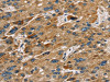 The image on the left is immunohistochemistry of paraffin-embedded Human liver cancer tissue using CSB-PA209693 (SULT1B1 Antibody) at dilution 1/30, on the right is treated with fusion protein. (Original magnification: ×200)