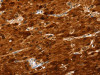 The image on the left is immunohistochemistry of paraffin-embedded Human liver cancer tissue using CSB-PA590135 (SULT2A1 Antibody) at dilution 1/25, on the right is treated with fusion protein. (Original magnification: ×200)