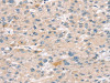 The image on the left is immunohistochemistry of paraffin-embedded Human liver cancer tissue using CSB-PA158594 (SULT2B1 Antibody) at dilution 1/25, on the right is treated with fusion protein. (Original magnification: ×200)