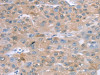 The image on the left is immunohistochemistry of paraffin-embedded Human liver cancer tissue using CSB-PA144328 (SULT2B1 Antibody) at dilution 1/20, on the right is treated with fusion protein. (Original magnification: ×200)