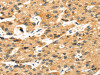The image on the left is immunohistochemistry of paraffin-embedded Human liver cancer tissue using CSB-PA299879 (STX8 Antibody) at dilution 1/35, on the right is treated with fusion protein. (Original magnification: ×200)