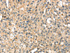 The image on the left is immunohistochemistry of paraffin-embedded Human breast cancer tissue using CSB-PA299879 (STX8 Antibody) at dilution 1/35, on the right is treated with fusion protein. (Original magnification: ×200)