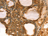 The image on the left is immunohistochemistry of paraffin-embedded Human thyroid cancer tissue using CSB-PA210339 (TAF11 Antibody) at dilution 1/40, on the right is treated with fusion protein. (Original magnification: ×200)