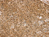 The image on the left is immunohistochemistry of paraffin-embedded Human esophagus cancer tissue using CSB-PA247131 (TAF12 Antibody) at dilution 1/35, on the right is treated with fusion protein. (Original magnification: ×200)