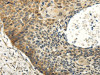 The image on the left is immunohistochemistry of paraffin-embedded Human esophagus cancer tissue using CSB-PA274413 (ABCB7 Antibody) at dilution 1/20, on the right is treated with fusion protein. (Original magnification: ×200)