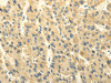The image on the left is immunohistochemistry of paraffin-embedded Human liver cancer tissue using CSB-PA109776 (ABCB7 Antibody) at dilution 1/20, on the right is treated with fusion protein. (Original magnification: ×200)