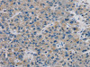 The image on the left is immunohistochemistry of paraffin-embedded Human liver cancer tissue using CSB-PA591960 (TBX18 Antibody) at dilution 1/20, on the right is treated with fusion protein. (Original magnification: ×200)