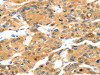 The image on the left is immunohistochemistry of paraffin-embedded Human liver cancer tissue using CSB-PA273921 (TBX18 Antibody) at dilution 1/20, on the right is treated with fusion protein. (Original magnification: ×200)