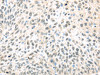 The image on the left is immunohistochemistry of paraffin-embedded Human lung cancer tissue using CSB-PA911518 (TCEB1 Antibody) at dilution 1/40, on the right is treated with fusion protein. (Original magnification: ×200)