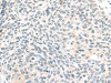 The image on the left is immunohistochemistry of paraffin-embedded Human lung cancer tissue using CSB-PA037081 (TCEB1 Antibody) at dilution 1/40, on the right is treated with fusion protein. (Original magnification: ×200)