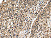 The image on the left is immunohistochemistry of paraffin-embedded Human lung cancer tissue using CSB-PA103304 (TFDP2 Antibody) at dilution 1/25, on the right is treated with fusion protein. (Original magnification: ×200)