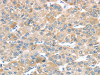 The image on the left is immunohistochemistry of paraffin-embedded Human liver cancer tissue using CSB-PA992989 (LEFTY2 Antibody) at dilution 1/20, on the right is treated with fusion protein. (Original magnification: ×200)