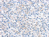 The image on the left is immunohistochemistry of paraffin-embedded Human prostate cancer tissue using CSB-PA992989 (LEFTY2 Antibody) at dilution 1/20, on the right is treated with fusion protein. (Original magnification: ×200)