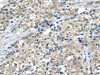 The image on the left is immunohistochemistry of paraffin-embedded Human breast cancer tissue using CSB-PA223153 (THAP4 Antibody) at dilution 1/20, on the right is treated with fusion protein. (Original magnification: ×200)