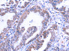 The image on the left is immunohistochemistry of paraffin-embedded Human esophagus cancer tissue using CSB-PA574019 (THRSP Antibody) at dilution 1/25, on the right is treated with fusion protein. (Original magnification: ×200)