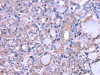 The image on the left is immunohistochemistry of paraffin-embedded Human thyroid cancer tissue using CSB-PA696718 (THRSP Antibody) at dilution 1/30, on the right is treated with fusion protein. (Original magnification: ×200)