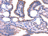 The image on the left is immunohistochemistry of paraffin-embedded Human thyroid cancer tissue using CSB-PA080676 (TRIM49 Antibody) at dilution 1/40, on the right is treated with fusion protein. (Original magnification: ×200)