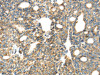 The image on the left is immunohistochemistry of paraffin-embedded Human thyroid cancer tissue using CSB-PA718808 (TIRAP Antibody) at dilution 1/30, on the right is treated with fusion protein. (Original magnification: ×200)