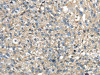 The image on the left is immunohistochemistry of paraffin-embedded Human breast cancer tissue using CSB-PA250986 (TMED1 Antibody) at dilution 1/35, on the right is treated with fusion protein. (Original magnification: ×200)