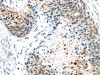 The image on the left is immunohistochemistry of paraffin-embedded Human esophagus cancer tissue using CSB-PA034529 (TMPRSS4 Antibody) at dilution 1/45, on the right is treated with fusion protein. (Original magnification: ×200)