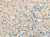 The image on the left is immunohistochemistry of paraffin-embedded Human liver cancer tissue using CSB-PA138752 (TMPRSS11A Antibody) at dilution 1/30, on the right is treated with fusion protein. (Original magnification: ×200)