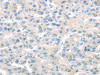 The image on the left is immunohistochemistry of paraffin-embedded Human liver cancer tissue using CSB-PA061292 (TMPRSS11A Antibody) at dilution 1/20, on the right is treated with fusion protein. (Original magnification: ×200)