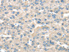 The image on the left is immunohistochemistry of paraffin-embedded Human liver cancer tissue using CSB-PA142964 (TNFAIP8 Antibody) at dilution 1/35, on the right is treated with fusion protein. (Original magnification: ×200)