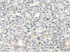 The image on the left is immunohistochemistry of paraffin-embedded Human breast cancer tissue using CSB-PA142964 (TNFAIP8 Antibody) at dilution 1/35, on the right is treated with fusion protein. (Original magnification: ×200)