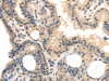 The image on the left is immunohistochemistry of paraffin-embedded Human thyroid cancer tissue using CSB-PA608547 (TPSB2 Antibody) at dilution 1/20, on the right is treated with fusion protein. (Original magnification: ×200)