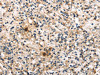 The image on the left is immunohistochemistry of paraffin-embedded Human prostate cancer tissue using CSB-PA608547 (TPSB2 Antibody) at dilution 1/20, on the right is treated with fusion protein. (Original magnification: ×200)