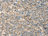 The image on the left is immunohistochemistry of paraffin-embedded Human liver cancer tissue using CSB-PA030905 (TPSB2 Antibody) at dilution 1/20, on the right is treated with fusion protein. (Original magnification: ×200)