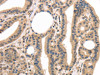 The image on the left is immunohistochemistry of paraffin-embedded Human thyroid cancer tissue using CSB-PA030905 (TPSB2 Antibody) at dilution 1/20, on the right is treated with fusion protein. (Original magnification: ×200)