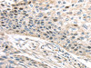 The image on the left is immunohistochemistry of paraffin-embedded Human esophagus cancer tissue using CSB-PA251071 (TPX2 Antibody) at dilution 1/40, on the right is treated with fusion protein. (Original magnification: ×200)