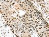 The image on the left is immunohistochemistry of paraffin-embedded Human esophagus cancer tissue using CSB-PA977634 (TALDO1 Antibody) at dilution 1/30, on the right is treated with fusion protein. (Original magnification: ×200)