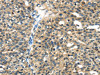 The image on the left is immunohistochemistry of paraffin-embedded Human breast cancer tissue using CSB-PA965532 (TGM5 Antibody) at dilution 1/30, on the right is treated with fusion protein. (Original magnification: ×200)