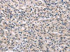 The image on the left is immunohistochemistry of paraffin-embedded Human prostate cancer tissue using CSB-PA922141 (MED28 Antibody) at dilution 1/30, on the right is treated with fusion protein. (Original magnification: ×200) The image on the left is immunohistochemistry of paraffin-embedded Human prostate cancer tissue using CSB-PA922141 (MED28 Antibody) at dilution 1/30, on the right is treated with fusion protein. (Original magnification: ×200)